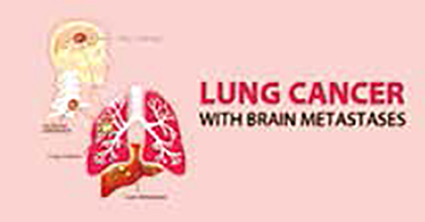 EGFR突變者腦轉(zhuǎn)移或更常見