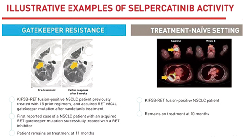 RET融合陽性NSCLC Selpercatinib療效持久且顱內(nèi)有效