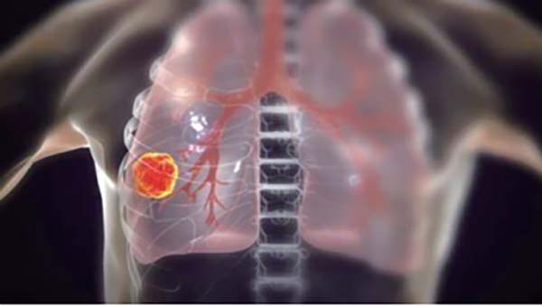 可切除的ⅢA~ⅢB期NSCLC 聯(lián)用納武利尤單抗對(duì)比單純新輔助化療更佳
