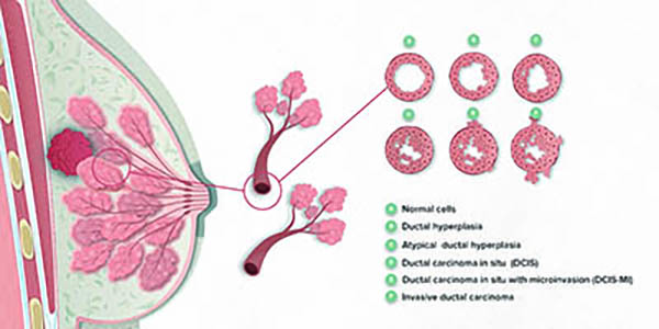 乳腺癌女性患者母乳中發(fā)現(xiàn)ctDNA
