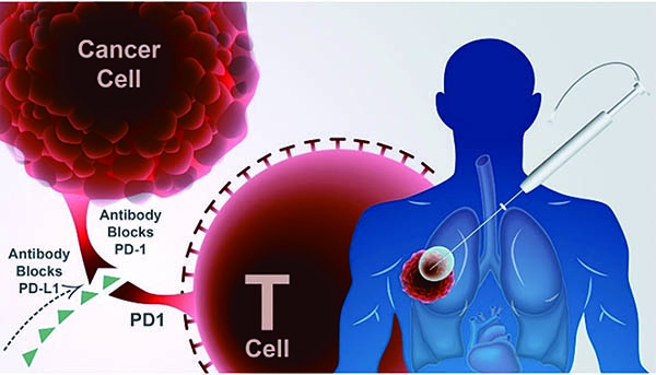 可切除的早期NSCLC 圍手術期免疫治療可改善患者預后 
