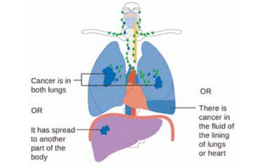 R0切除且為pN2期NSCLC 化療序貫放療輔助治療改善生存更好