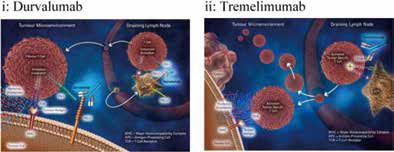 Tremelimumab聯(lián)合Durvalumab治療惡性間皮瘤值得研究
