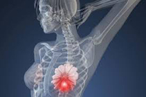 非遺傳性乳腺癌對側(cè)乳房預(yù)防性切除術(shù)患者的心理結(jié)局