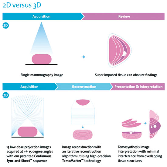 研究表明3D鉬靶是更準(zhǔn)確的乳腺癌篩查方法