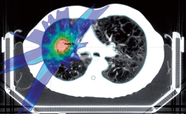 T1~3N0M0期NSCLC 立體定向放療后或不宜輔助化療