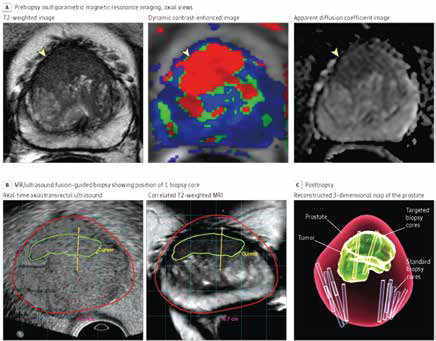 前列腺癌 mp-MRI、MRI引導的活檢及系統(tǒng)活檢均可區(qū)分高危病理特征