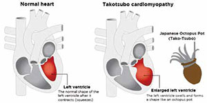 1/6的Takotsubo心肌病患者合并惡性腫瘤