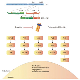 克唑替尼難治性ALK陽(yáng)性NSCLC Brigatinib明顯改善PFS和顱內(nèi)緩解情況