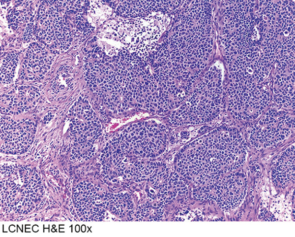 免疫檢查點(diǎn)抑制劑對LCNEC的療效類似NSCLC