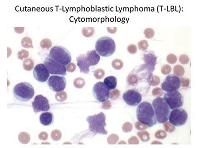 新發(fā)的兒童期T-LL 應(yīng)用C-MTX的COG ABFM方案結(jié)局較優(yōu)