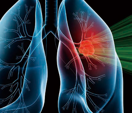 一線治療晚期非鱗狀NSCLC 含鉑化療聯(lián)合信迪利單抗或改善生存