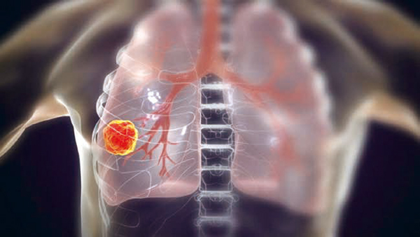 一線治療ALK陽性晚期NSCLC Ensartinib或優(yōu)于克唑替尼
