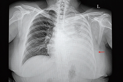 ICI治療NSCLC 胸腔積液提示免疫治療結(jié)局更差