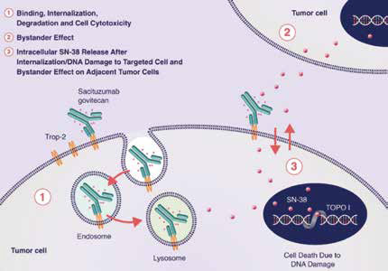 轉(zhuǎn)移性三陰性乳腺癌 Sacituzumab Govitecan在某些患者中優(yōu)于化療