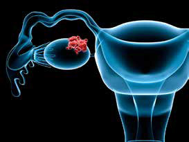 BRCA1/2基因突變攜帶者 輸卵管切除術(shù)后生活質(zhì)量仍較優(yōu)