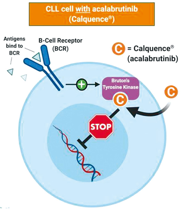 治療CLL Acalabrutinib或非劣效于依魯替尼
