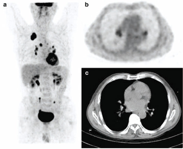 最大徑10.1~30.0 mm的實(shí)性NSCLC 術(shù)前CT和SUVmax預(yù)測(cè)縱隔淋巴結(jié)轉(zhuǎn)移不敏感