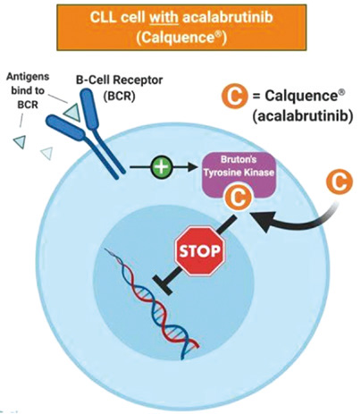 一線治療慢性淋巴細(xì)胞白血病 Acalabrutinib、維奈克拉聯(lián)合奧比妥珠單抗有研究?jī)r(jià)值