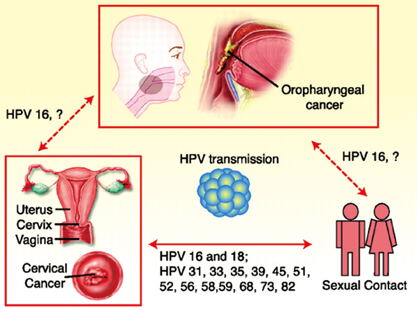 HPV相關(guān)腫瘤 解剖部位分層或可預(yù)測(cè)預(yù)后