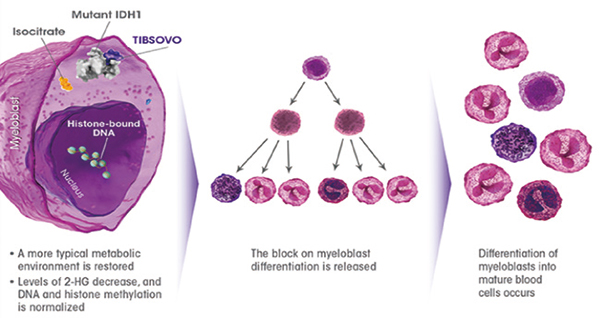 攜帶mIDH1難治性新發(fā)AML 聯(lián)合Ivosidenib優(yōu)于單用阿扎胞苷