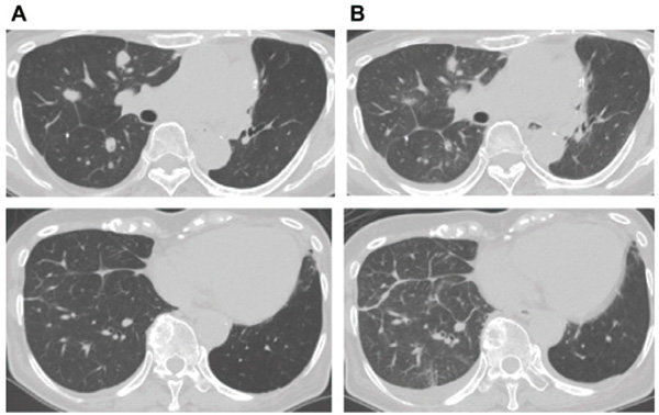 一線治療NSCLC 奧希替尼相關(guān)性肺炎發(fā)生率為 18%