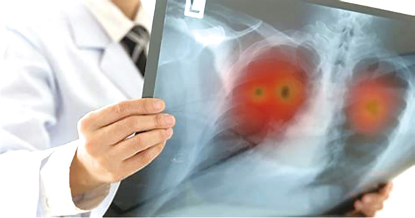 無驅(qū)動基因突變Ⅱ~Ⅲ期NSCLC 聯(lián)合Adebrelimab的新輔助方案或較佳