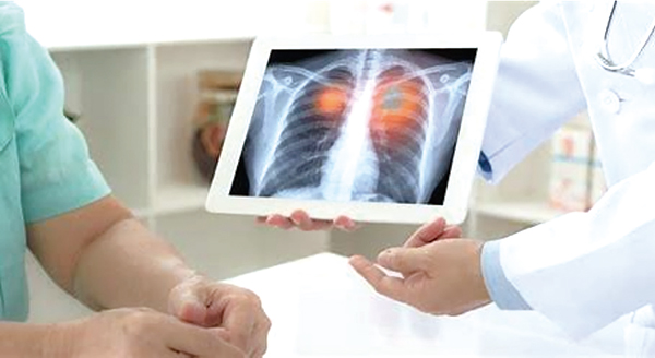 RET融合陽性NSCLC 早使用Selpercatinib或有預防CNS轉移作用