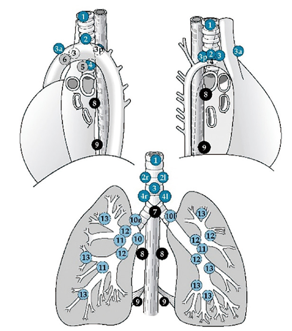 cT1N0期浸潤(rùn)性NSCLC 縱隔淋巴結(jié)轉(zhuǎn)移模式可被預(yù)測(cè)