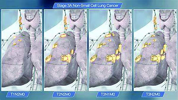Ⅱ~ⅢA期非鱗狀NSCLC PemP輔助化療療效與NP相似