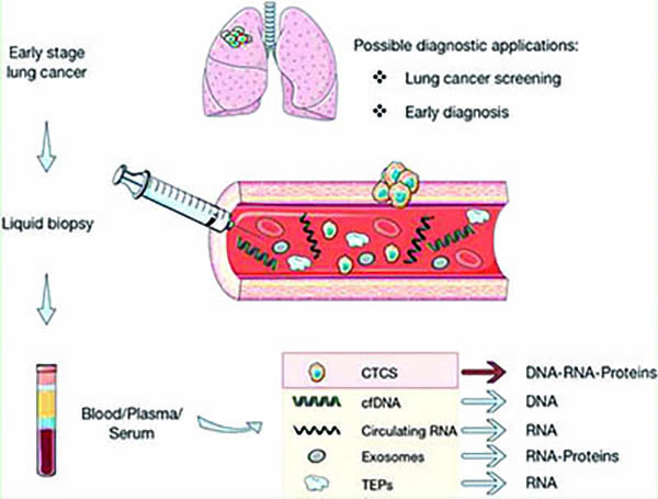 液體活檢或有助于識(shí)別出放療獲益的NSCLC