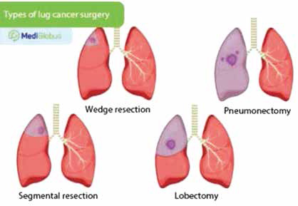 純實(shí)性NSCLC 肺段切除術(shù)生存獲益因年齡和性別而異