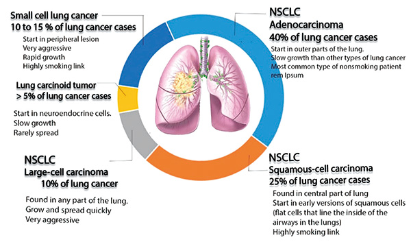 晚期鱗狀NSCLC 派安普利單抗聯(lián)合化療或?yàn)樾碌囊痪€方案