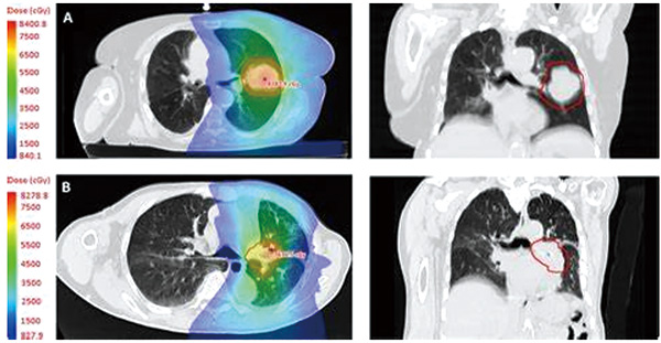 合并間質(zhì)性肺病的早期NSCLC 權衡風險和獲益后可使用SABR