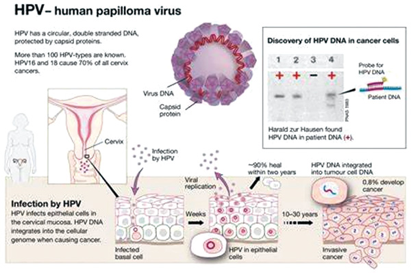 HPV ctDNA或不能指導(dǎo)口咽癌的輔助治療 