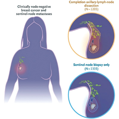 前哨淋巴結轉移乳腺癌 不接受腋窩淋巴結清掃不劣效于手術