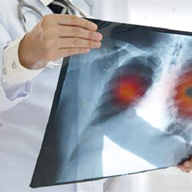 一線免疫治療轉(zhuǎn)移性NSCLC 緩解率和PFS僅與OS中度相關