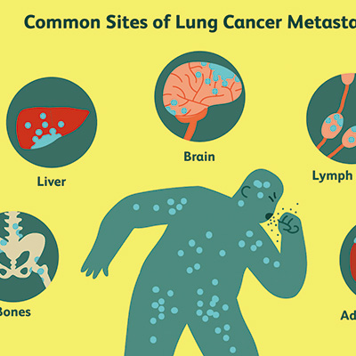 HER2過表達、不可切除/轉(zhuǎn)移性NSCLC T-DXd初顯抗腫瘤活性