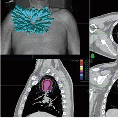 中央型局限性不可切除早期NSCLC SBRT與可接受的局部控制率相關(guān)