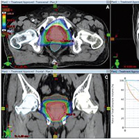 NRG Oncology RTOG 0415長期分析 大分割放療依舊非劣效于常規(guī)分割放療 
