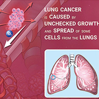 局部晚期NSCLC 同步化放療時采用IMRT有更好的長期療效