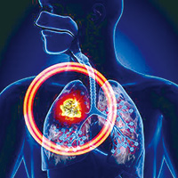 不可切除的Ⅲ期NSCLC 新輔助應用阿替利珠單抗值得研究