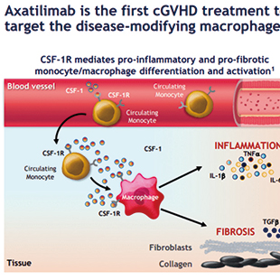 復(fù)發(fā)或難治性慢性GVHD axatilimab治療可帶來較高的緩解率