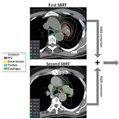 復(fù)發(fā)性NSCLC 胸部再放療和鞏固性免疫療法均可選